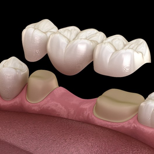 A 3D illustration of a dental bridge