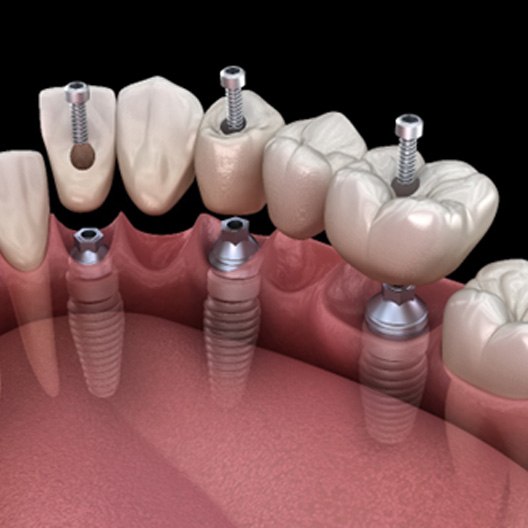 A 3D illustration of an implant bridge 