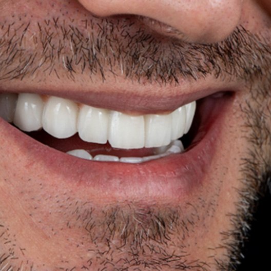 A closeup of a bearded man with a dental bridge