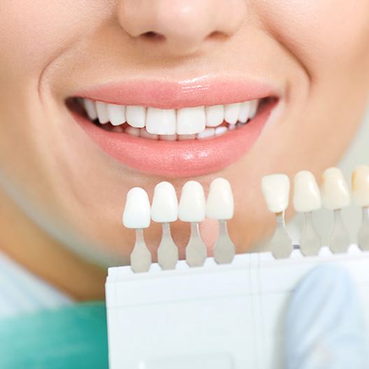 Woman's smile compared with porcelain veneer shade chart