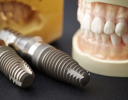 a mouth mold placed next to two models of dental implants