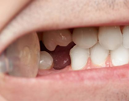 Smile with knocked out tooth