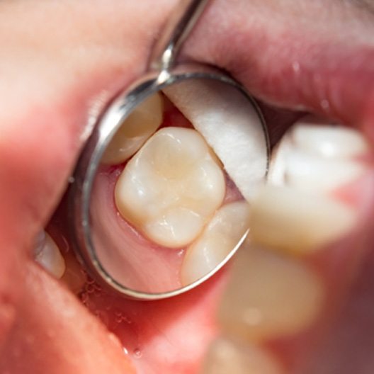 Dental mirror showing tooth-colored filling in Arlington