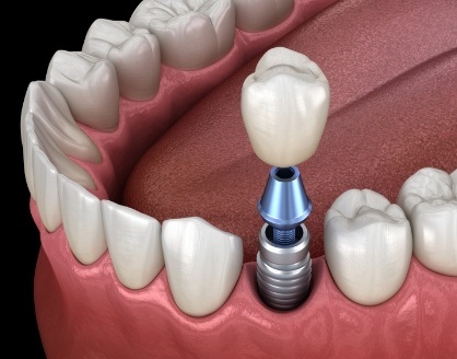 Animated dental implant supported dental crown placement