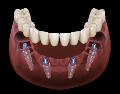 Animated dental implant supported denture placement