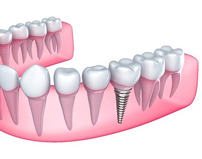 Single dental implant in Arlington, TX for lower arch