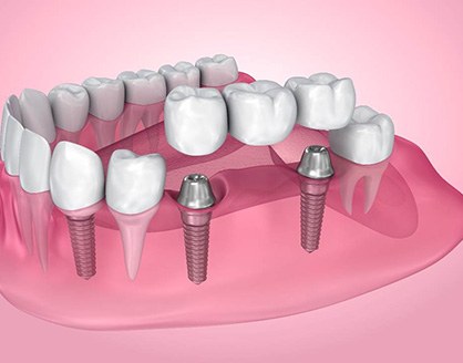 Dental bridge and dental implants in Arlington, TX