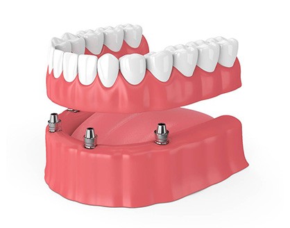 Illustration of dentures and dental implants in Arlington, TX