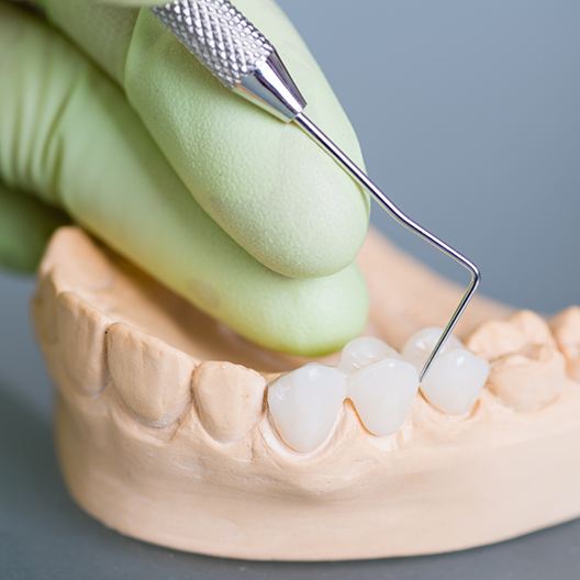 Model smile with dental bridge restoration