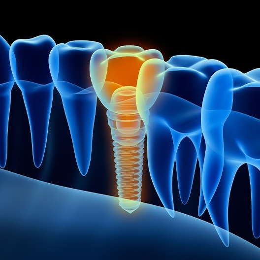 Animated dental implant supported dental crown